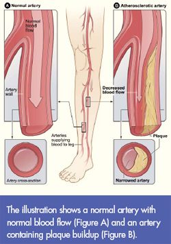 The illustration shows a normal artery with normal blood flow (Figure A) and an artery containing plaque buildup (Figure B).