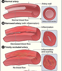 Vasculitis illustration