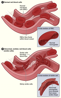Illustration of two figures. Top figure shows normal red blood cells flowing freely in a blood vessel. The inset image shows a cross-section of a normal red blood cell with normal hemoglobin. Bottom figure shows abnormal, sickled red blood cells clumping and blocking blood flow in a blood vessel. The inset image shows a cross-section of a sickle cell with abnormal hemoglobin.